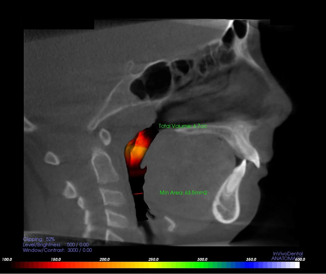 Airway volume and minimum-area measurements on a three-dimensional X-ray