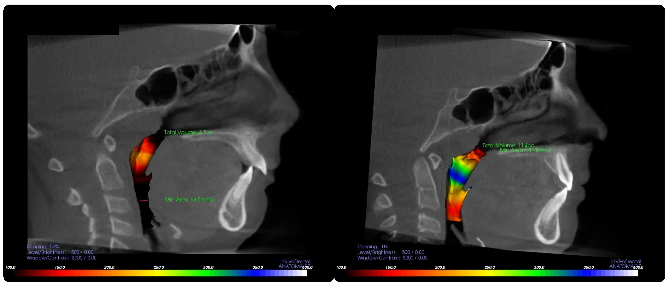 Before and after X-rays showing the airway volume and minimum-area measurements