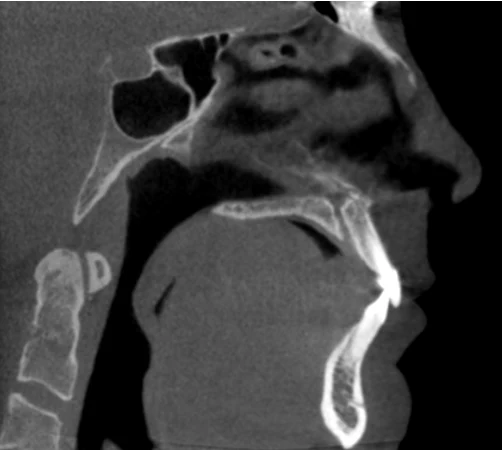 Three-dimensional X-ray cross section of the airway