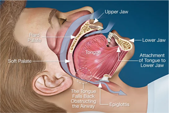 Diagram showing how tongue position can affect airflow