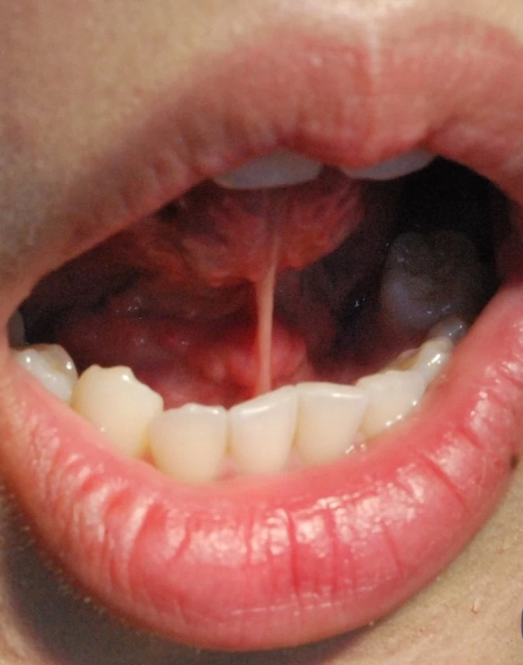 Clinical photograph showing a tongue tie