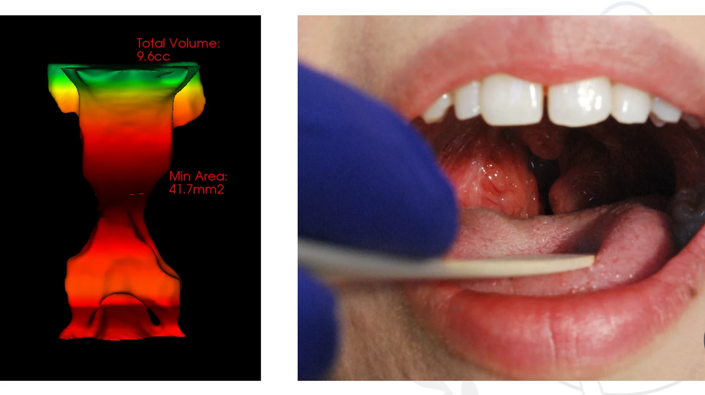 Illustration of enlarged tonsils and an airway volume analysis